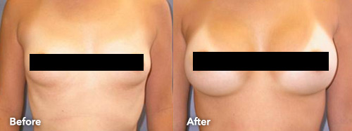 Does kaiser permanente cover breast reduction one cognizant gsd